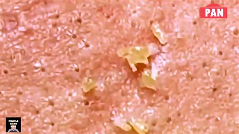 Best of Beauty 2016: Skin. . Pimple popping videos 2021 blackheads youtube